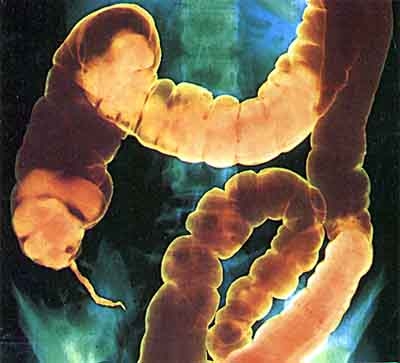 imagini intestinul gros